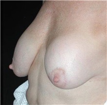 Breast Reduction Before Photo by Frederick Lukash, MD, FACS, FAAP; East Hills, NY - Case 35070