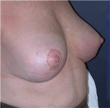 Breast Reduction After Photo by Frederick Lukash, MD, FACS, FAAP; East Hills, NY - Case 35070