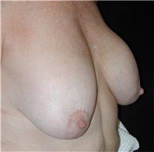 Breast Reduction Before Photo by Frederick Lukash, MD, FACS, FAAP; East Hills, NY - Case 35070