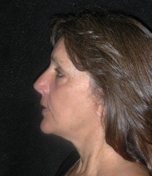 Facelift After Photo by Frederick Lukash, MD, FACS, FAAP; East Hills, NY - Case 35071
