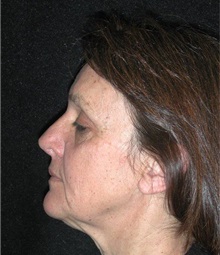 Facelift Before Photo by Frederick Lukash, MD, FACS, FAAP; East Hills, NY - Case 35071