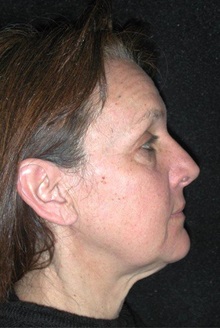 Facelift Before Photo by Frederick Lukash, MD, FACS, FAAP; East Hills, NY - Case 35071