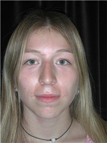 Rhinoplasty After Photo by Frederick Lukash, MD, FACS, FAAP; East Hills, NY - Case 35076