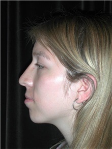 Rhinoplasty After Photo by Frederick Lukash, MD, FACS, FAAP; East Hills, NY - Case 35076