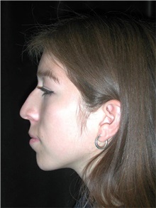 Rhinoplasty Before Photo by Frederick Lukash, MD, FACS, FAAP; East Hills, NY - Case 35076