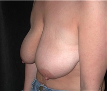 Breast Lift Before Photo by Frederick Lukash, MD, FACS, FAAP; East Hills, NY - Case 35118