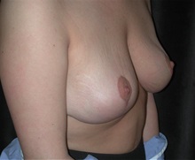 Breast Lift After Photo by Frederick Lukash, MD, FACS, FAAP; East Hills, NY - Case 35118