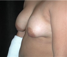 Breast Lift Before Photo by Frederick Lukash, MD, FACS, FAAP; East Hills, NY - Case 35120