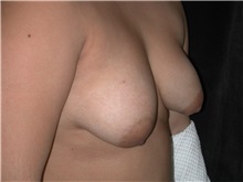 Breast Lift Before Photo by Frederick Lukash, MD, FACS, FAAP; East Hills, NY - Case 35120