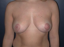 Breast Reduction After Photo by Frederick Lukash, MD, FACS, FAAP; East Hills, NY - Case 35121
