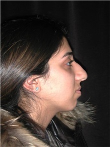 Rhinoplasty Before Photo by Frederick Lukash, MD, FACS, FAAP; East Hills, NY - Case 35122