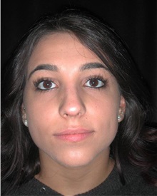 Rhinoplasty After Photo by Frederick Lukash, MD, FACS, FAAP; East Hills, NY - Case 35123