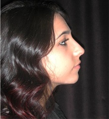 Rhinoplasty After Photo by Frederick Lukash, MD, FACS, FAAP; East Hills, NY - Case 35123