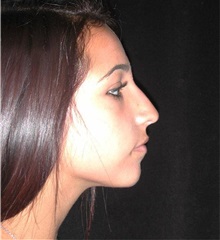 Rhinoplasty Before Photo by Frederick Lukash, MD, FACS, FAAP; East Hills, NY - Case 35123