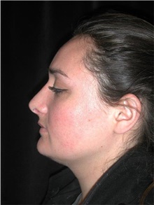 Rhinoplasty After Photo by Frederick Lukash, MD, FACS, FAAP; East Hills, NY - Case 35124