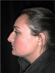Rhinoplasty Before Photo by Frederick Lukash, MD, FACS, FAAP; East Hills, NY - Case 35124