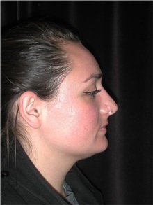 Rhinoplasty After Photo by Frederick Lukash, MD, FACS, FAAP; East Hills, NY - Case 35124