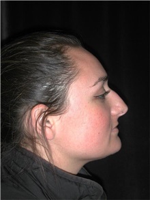 Rhinoplasty Before Photo by Frederick Lukash, MD, FACS, FAAP; East Hills, NY - Case 35124