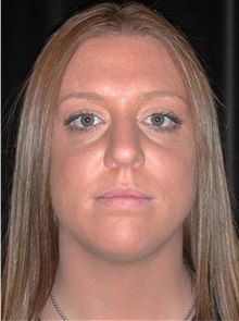 Rhinoplasty After Photo by Frederick Lukash, MD, FACS, FAAP; East Hills, NY - Case 35125