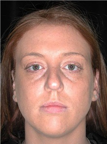 Rhinoplasty Before Photo by Frederick Lukash, MD, FACS, FAAP; East Hills, NY - Case 35125