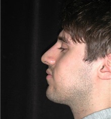 Rhinoplasty After Photo by Frederick Lukash, MD, FACS, FAAP; East Hills, NY - Case 35126