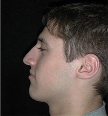 Rhinoplasty Before Photo by Frederick Lukash, MD, FACS, FAAP; East Hills, NY - Case 35126