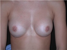 Breast Augmentation After Photo by Frederick Lukash, MD, FACS, FAAP; East Hills, NY - Case 35128