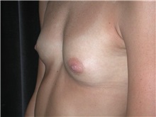 Breast Augmentation Before Photo by Frederick Lukash, MD, FACS, FAAP; East Hills, NY - Case 35128