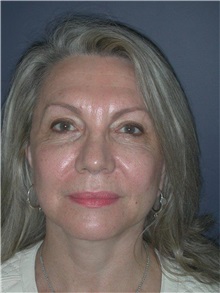 Facelift After Photo by Frederick Lukash, MD, FACS, FAAP; East Hills, NY - Case 35129