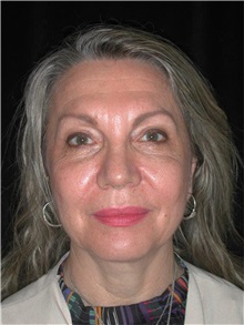 Facelift Before Photo by Frederick Lukash, MD, FACS, FAAP; East Hills, NY - Case 35129