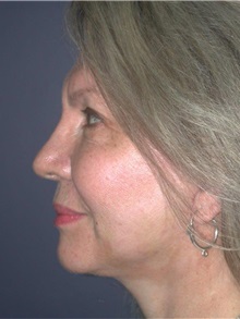 Facelift After Photo by Frederick Lukash, MD, FACS, FAAP; East Hills, NY - Case 35129