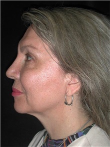 Facelift Before Photo by Frederick Lukash, MD, FACS, FAAP; East Hills, NY - Case 35129