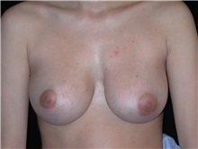 Breast Augmentation After Photo by Frederick Lukash, MD, FACS, FAAP; East Hills, NY - Case 35130