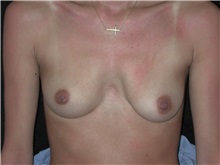 Breast Augmentation Before Photo by Frederick Lukash, MD, FACS, FAAP; East Hills, NY - Case 35130