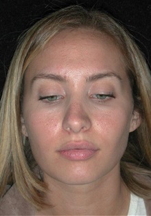 Rhinoplasty After Photo by Frederick Lukash, MD, FACS, FAAP; East Hills, NY - Case 35131
