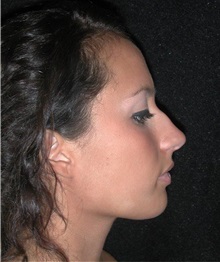 Rhinoplasty Before Photo by Frederick Lukash, MD, FACS, FAAP; East Hills, NY - Case 35131