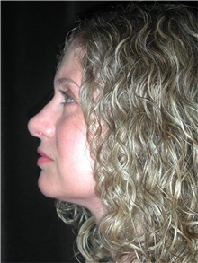 Rhinoplasty After Photo by Frederick Lukash, MD, FACS, FAAP; East Hills, NY - Case 35132
