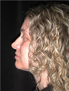 Rhinoplasty Before Photo by Frederick Lukash, MD, FACS, FAAP; East Hills, NY - Case 35132