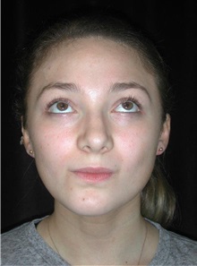 Rhinoplasty After Photo by Frederick Lukash, MD, FACS, FAAP; East Hills, NY - Case 35133