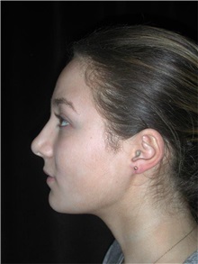 Rhinoplasty After Photo by Frederick Lukash, MD, FACS, FAAP; East Hills, NY - Case 35133