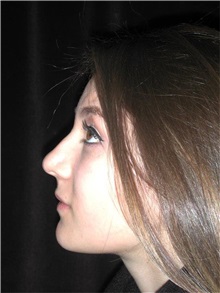 Rhinoplasty Before Photo by Frederick Lukash, MD, FACS, FAAP; East Hills, NY - Case 35133