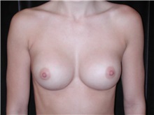 Breast Augmentation After Photo by Frederick Lukash, MD, FACS, FAAP; East Hills, NY - Case 35134