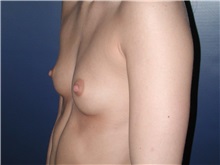 Breast Augmentation Before Photo by Frederick Lukash, MD, FACS, FAAP; East Hills, NY - Case 35134