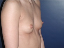 Breast Augmentation Before Photo by Frederick Lukash, MD, FACS, FAAP; East Hills, NY - Case 35134