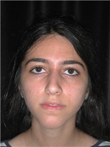 Rhinoplasty After Photo by Frederick Lukash, MD, FACS, FAAP; East Hills, NY - Case 35135