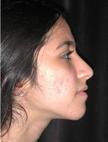 Rhinoplasty After Photo by Frederick Lukash, MD, FACS, FAAP; East Hills, NY - Case 35135