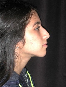 Rhinoplasty Before Photo by Frederick Lukash, MD, FACS, FAAP; East Hills, NY - Case 35135