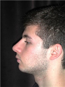 Rhinoplasty After Photo by Frederick Lukash, MD, FACS, FAAP; East Hills, NY - Case 35136