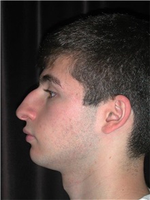 Rhinoplasty Before Photo by Frederick Lukash, MD, FACS, FAAP; East Hills, NY - Case 35136