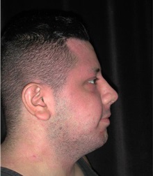 Rhinoplasty After Photo by Frederick Lukash, MD, FACS, FAAP; East Hills, NY - Case 35137